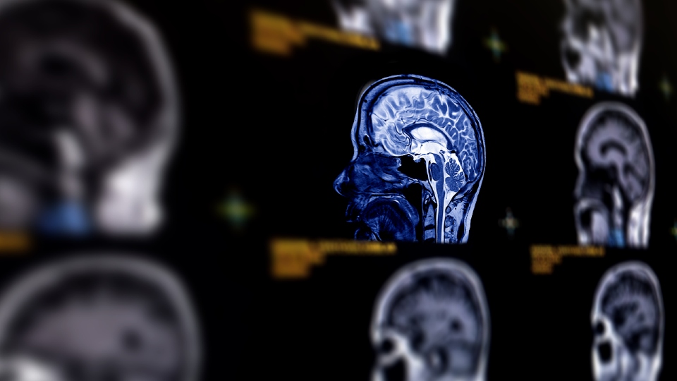 Image from an MRI scan showing a human face pointing to the left and the human brain can be seen.