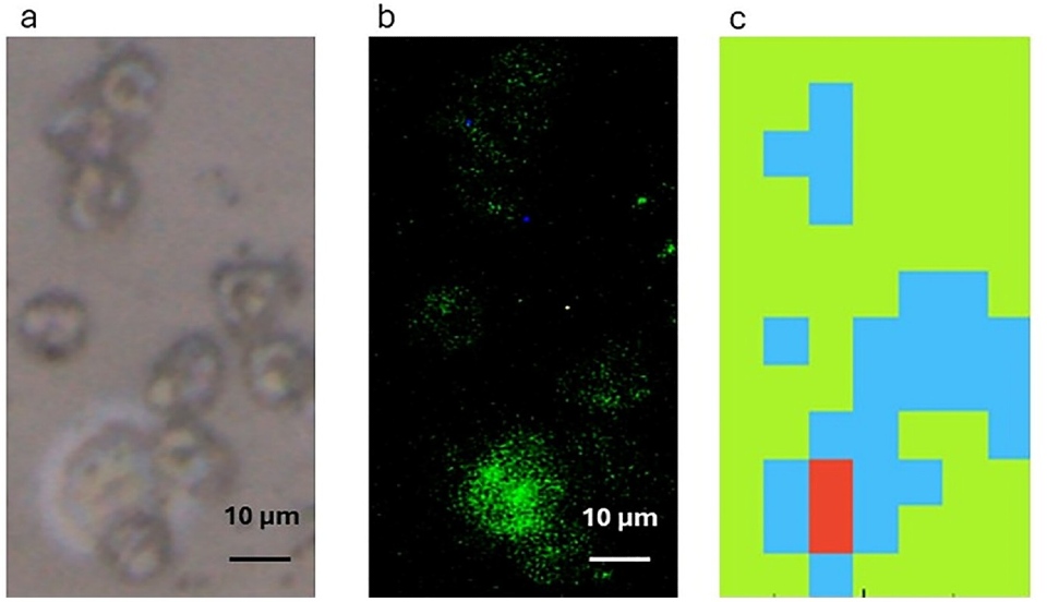 This figure shows how the technique identifies a single circulating tumour cell (CTC) in a lung cancer patient’s blood sample. The sample is first viewed under a microscope (a), and, after being tested, the cancer cell is then stained (b) so the researchers can confirm it is a cancer cell. The Fourier Transform Infrared (FT-IR) microspectroscopy technique produces a colour-coded map (c) distinguis
