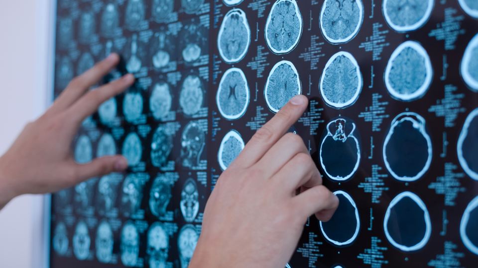 A person pointing at x-ray images of a human brain.